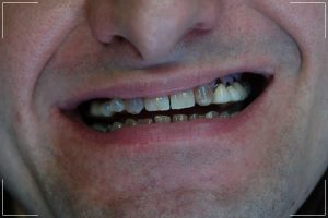 a before image of a male patient’s smile getting a smile makeover