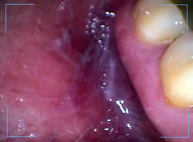 image of the inside of a patients gums and teeth