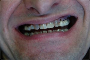 man with decayed and cracked teeth before his smile makeover