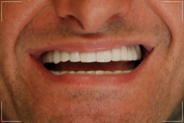 the after image of a male patient’s smile makeover