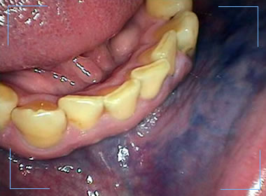 inside of patients bottom teeth and purple tissue