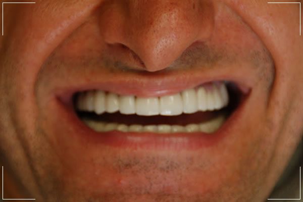 man with a repaired smile after a complete smile makeover