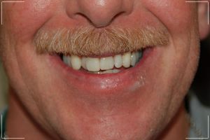 older man with some misaligned and crooked teeth before receiving crowns or bridges