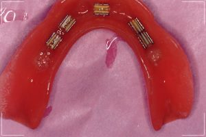 a gum colored bottom implant denture