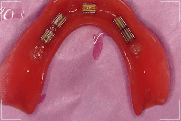 a gum colored bottom implant denture