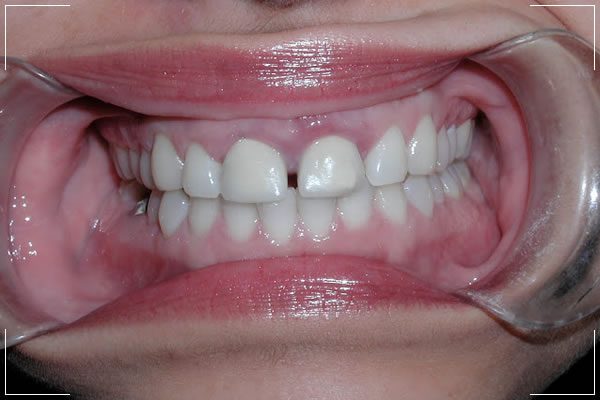 woman with a mild front gapped teeth