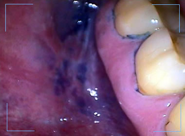 image of inside of patient’s infected mouth