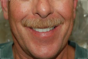after image of an older man with new dental crowns or bridges