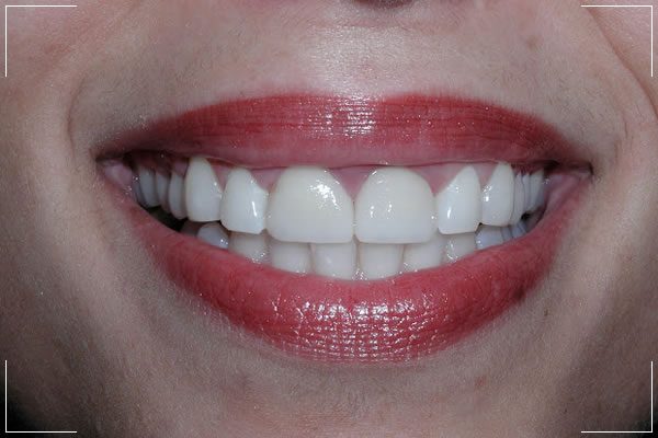 woman with gap now has a repaired smile