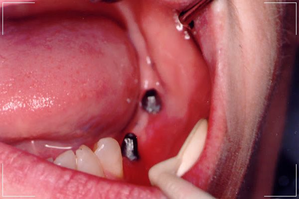 the inside of patient’s mouth with 2 implants
