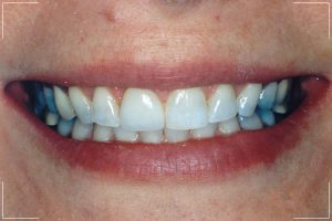 woman with her new teeth after her smile makeover