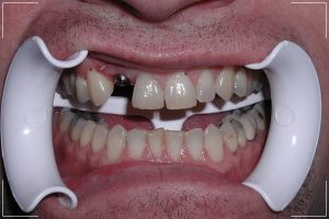 a man with a missing tooth and an single implant replacement