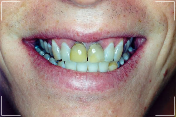 man with decayed front teeth receiving a smile makeover