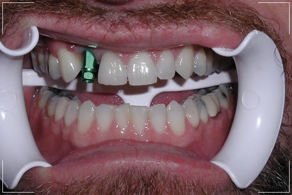 a man with a missing tooth receiving his single dental implant