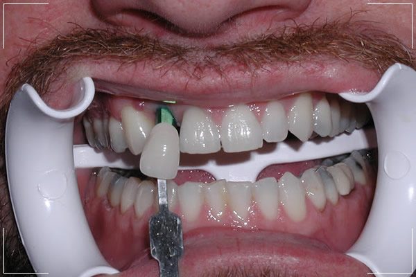 a man with a missing tooth receiving his final restoration for his single dental implant