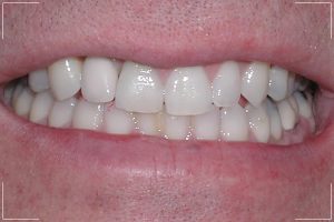 a man’s new smile with dental implants