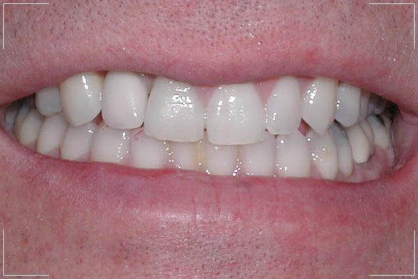 a man’s new smile with dental implants