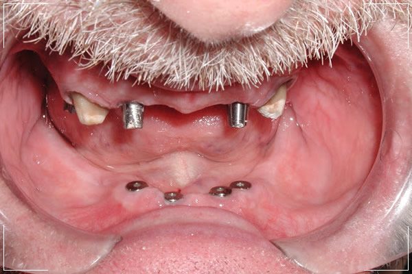 an older man receiving dental implants in both jaws