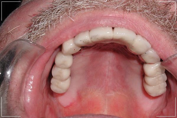 an image of an older man’s upper palate with his implant dentures