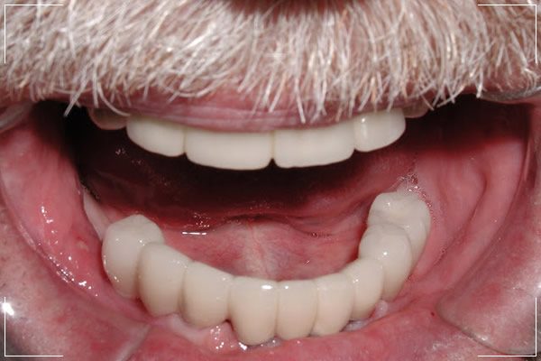 an image of an older man’s lower jaw with his implant dentures