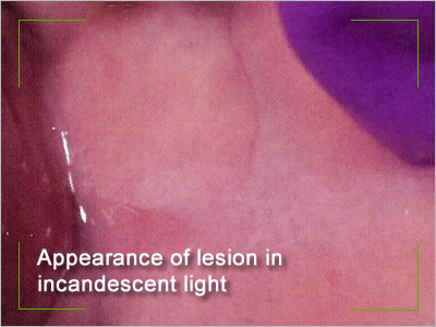 Leukoedema lesion in incandescent light