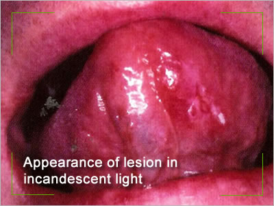 carcinoma lesion in incandescent light