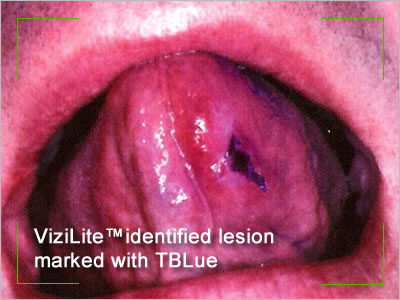 carcinoma lesion marked with TBlue