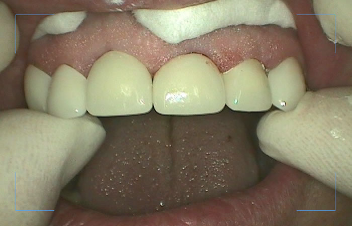 Cosmetic patient case after the procedure