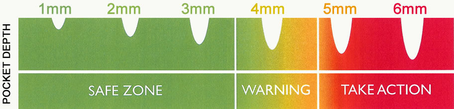 Perio Pocket Chart