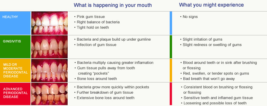 a graph on the stages of periodontal disease