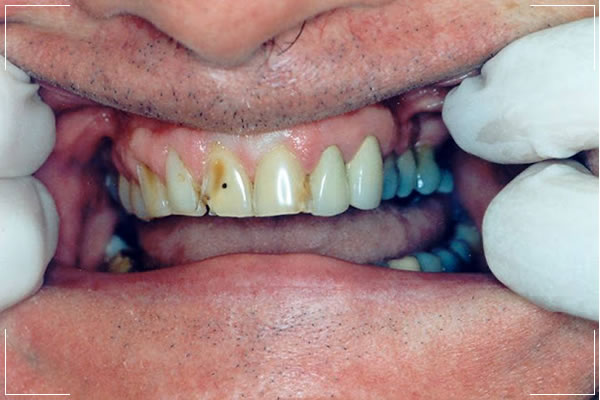 before image of a male patient's cracked and decayed teeth