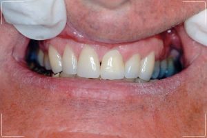 after image of a male patient's veneers