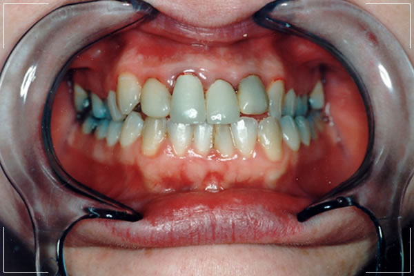 before image of a female patient's decayed teeth