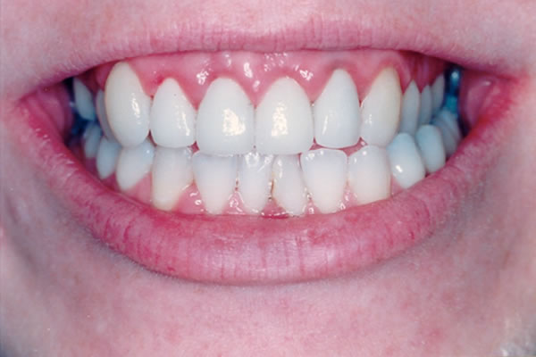 after image of a female patient's new veneers