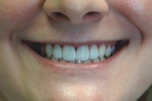 a woman smiling with her new veneers