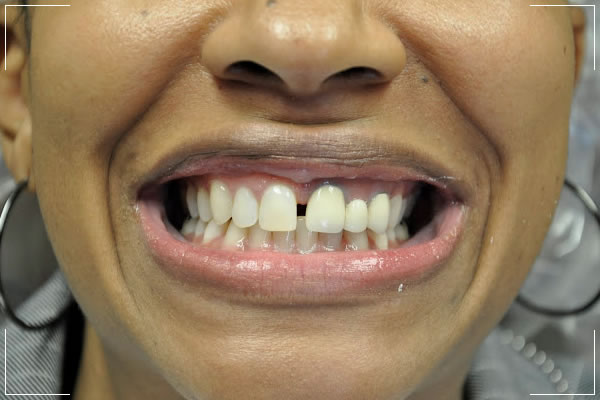 a woman with some decayed teeth and gapped front teeth