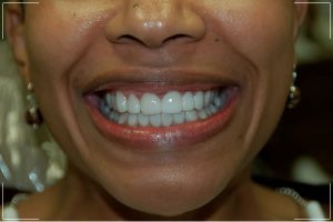 a woman with veneers that repairs her decayed teeth and gapped front teeth