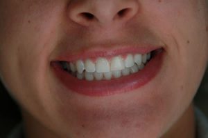 close-up of a new smile with veneers