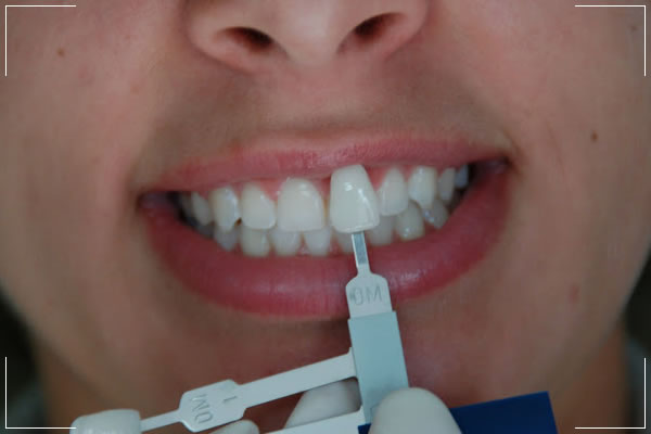 an image of doctor comparing the color and shape of veneers with natural teeth