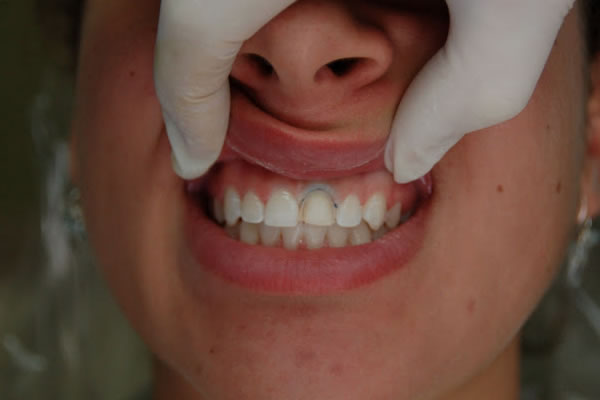 mid process of patient receiving veneers on a tooth