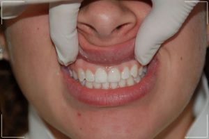 finished process of a patient with veneers on his front tooth