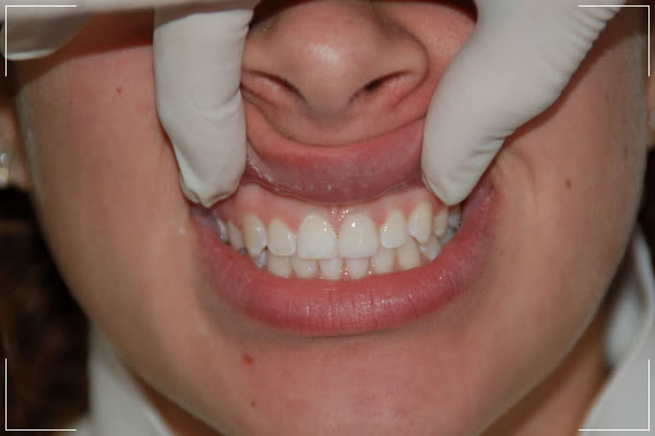 finished process of a patient with veneers on his front tooth