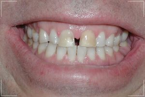 before image of patient who needs veneers for their gapped front teeth