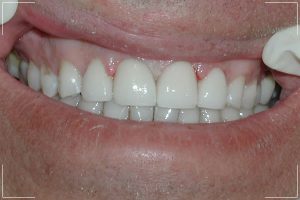 after image of a patient with new front teeth veneers