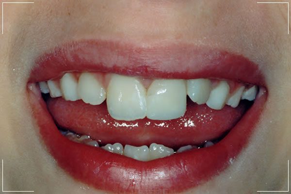 Dental Emergency After