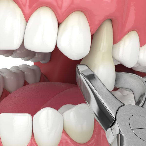 tooth extraction