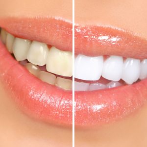 teeth whitening