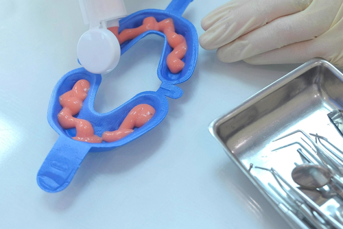 fluoride treatment