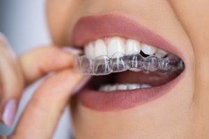 woman putting in ClearCorrect Aligners