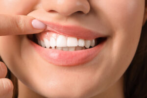 Close-up of a woman pointing to her gums, highlighting healthy teeth and gum line, relevant to gum recession treatment at Perrott Dentistry in Boardman, OH.